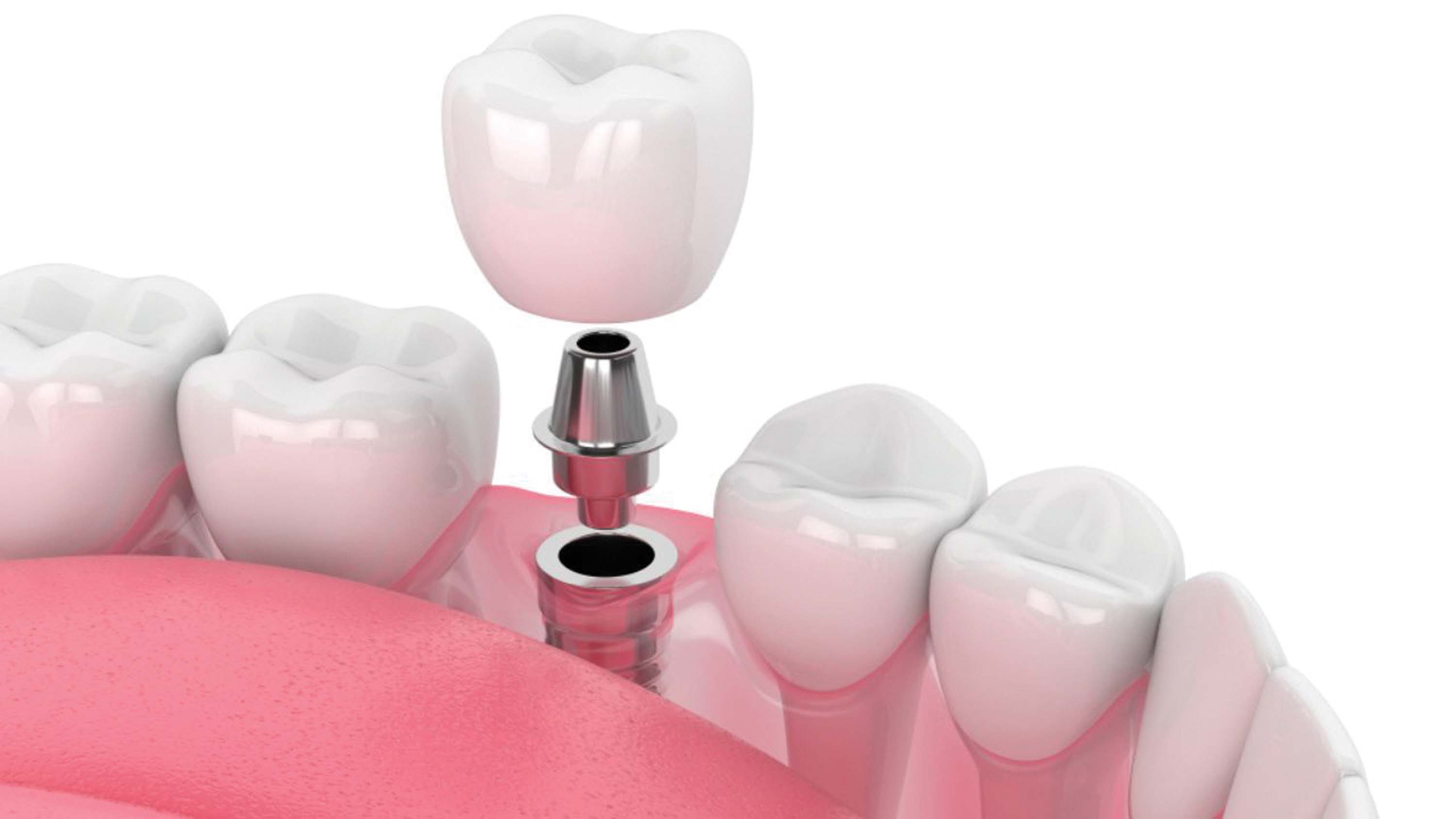 Protese-unitaria-fixa